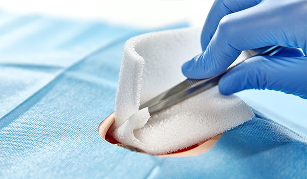 The hydrophilic debridement foam is well suited for cleaning deep and hard-to-reach wounds.